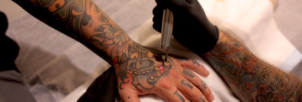 laser tattoo removal adelaide body ink removal 100 safe laser tattoo removal adelaide body ink removal 100 safe