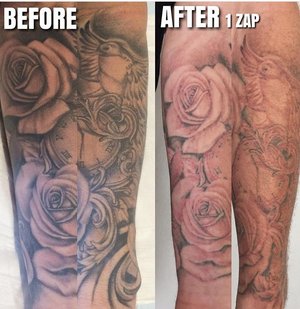 laser tattoo removal clinic unley the tattoo removal co 0431 756 944 laser tattoo removal clinic unley the tattoo removal co 0431 756 944