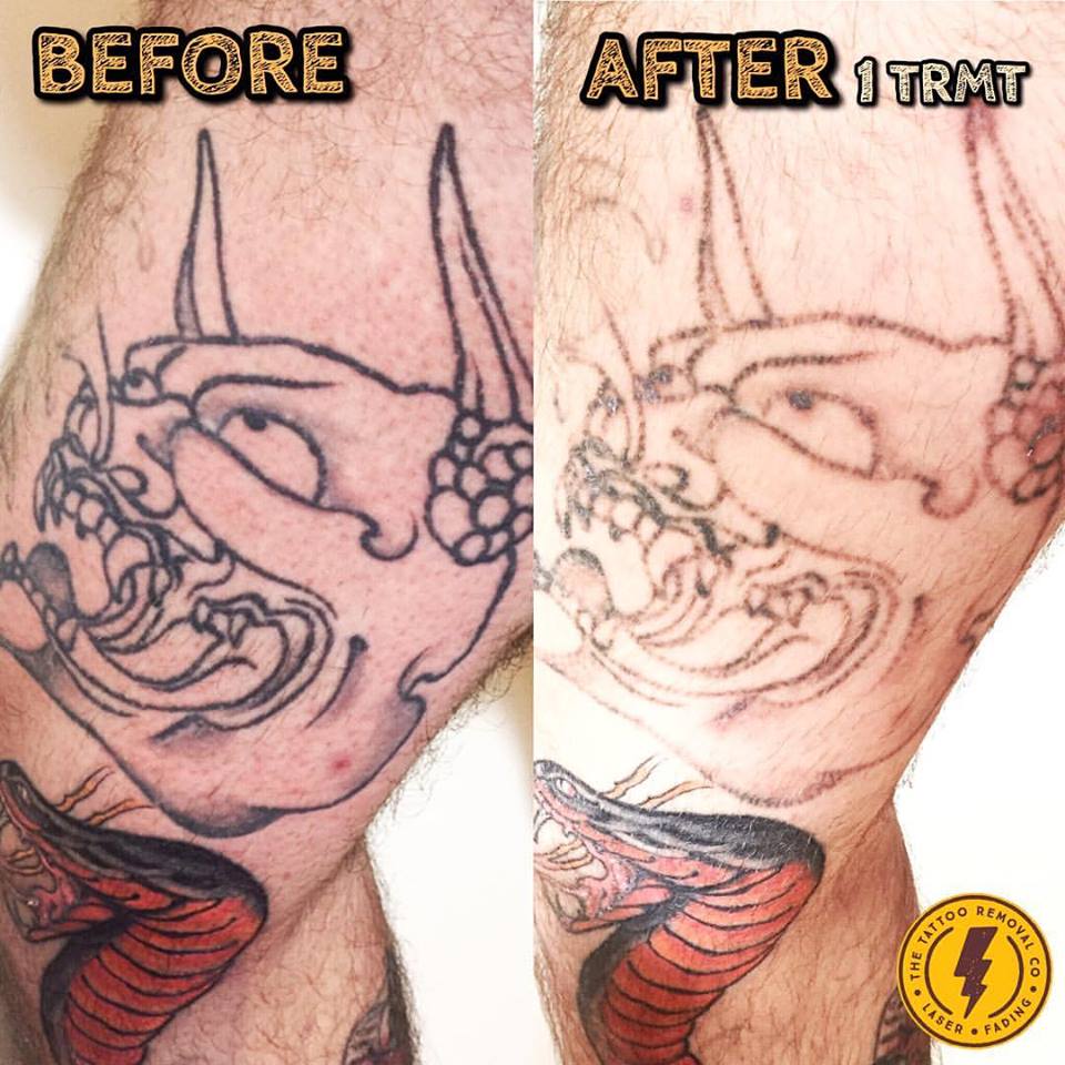 laser tattoo removal clinic beulah park the tattoo removal co laser tattoo removal clinic beulah park the tattoo removal co