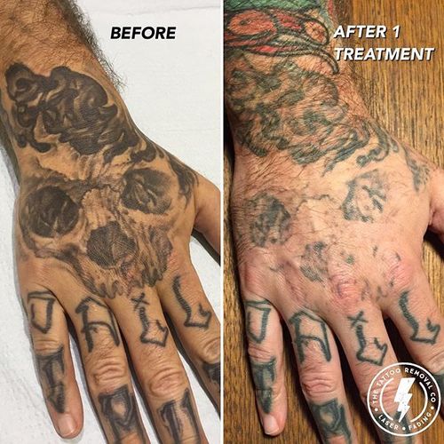 laser tattoo removal clinic norwood the tattoo removal co 0431 laser tattoo removal clinic norwood the tattoo removal co 0431