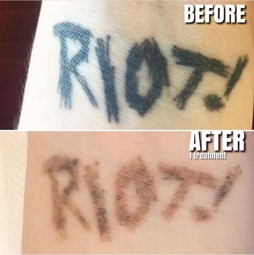 laser tattoo removal clinic pasadena the tattoo removal co 0431 laser tattoo removal clinic pasadena the tattoo removal co 0431