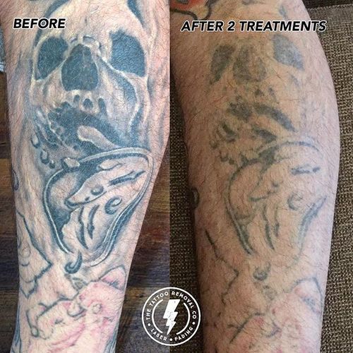 Laser Tattoo Removal