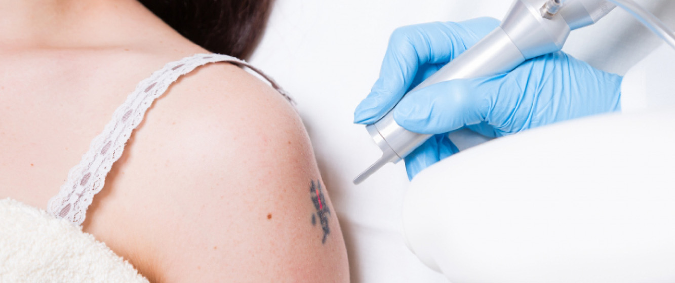 Laser Tattoo Removal Laser Tattoo Removal